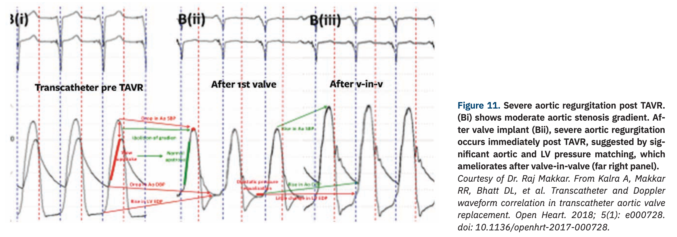 Hemodynamics That Can Make For a Lifesaving Decision in the Cath Lab